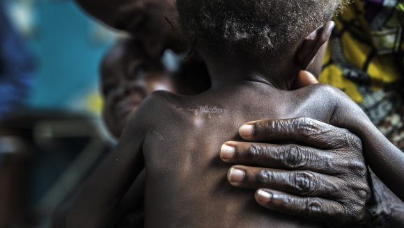 Kongo Mangelernährung Ärzte ohne Grenzen