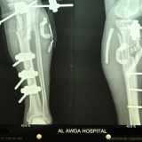 Knochenbruch, Schussverletzung, Gaza